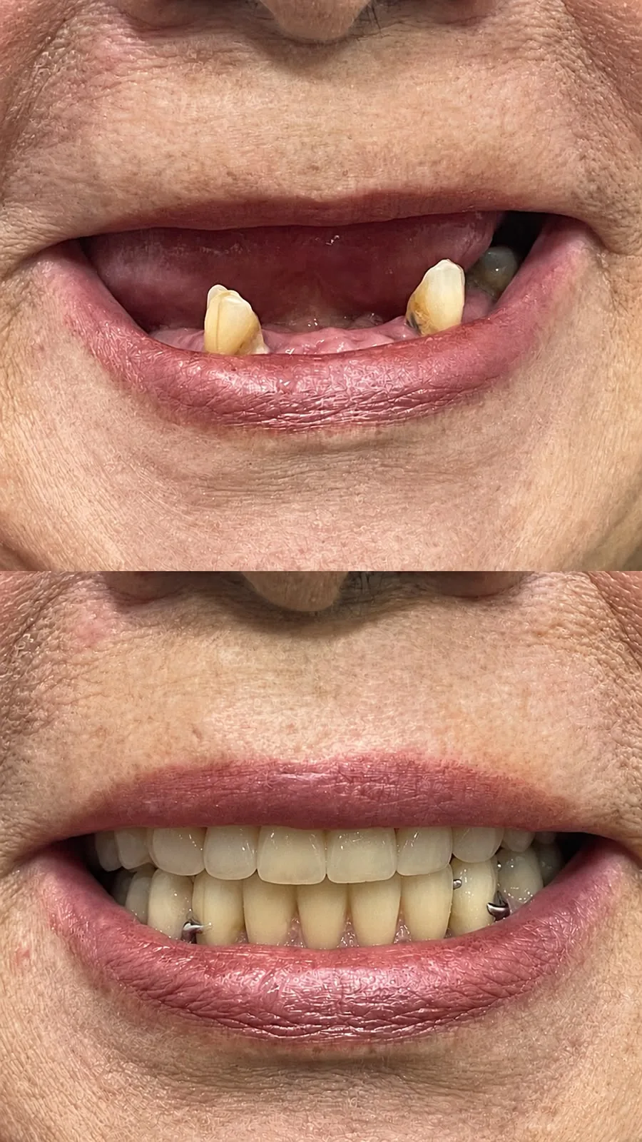Prótese dental